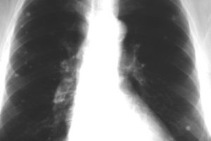 lung nodules