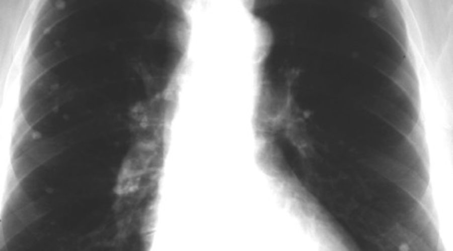 lung nodules